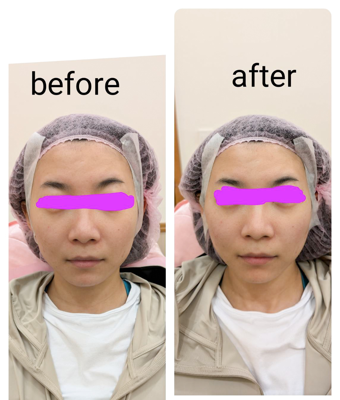 玻尿酸拉提術：為什麼「沒打法令紋」，紋路卻變淡了？