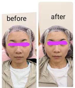 玻尿酸拉提術：為什麼「沒打法令紋」，紋路卻變淡了？